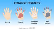 Frostbite Stages